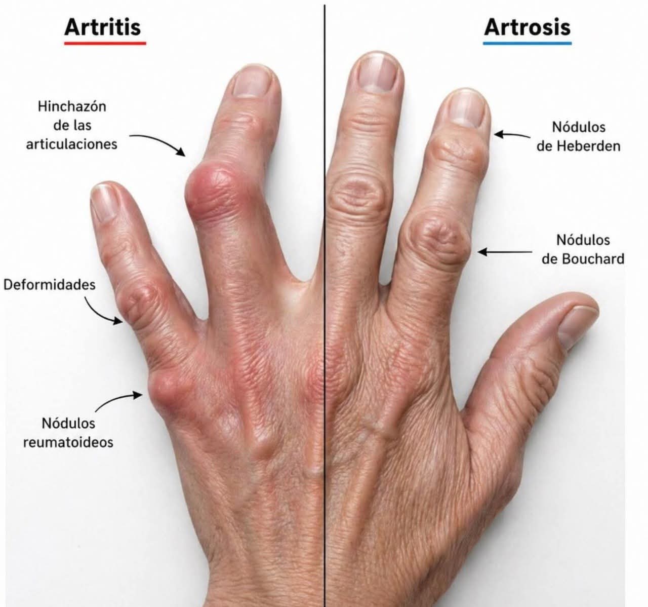 artitris, artrosis