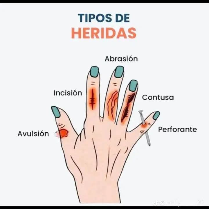 heridas