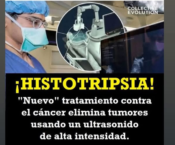 histotripsia