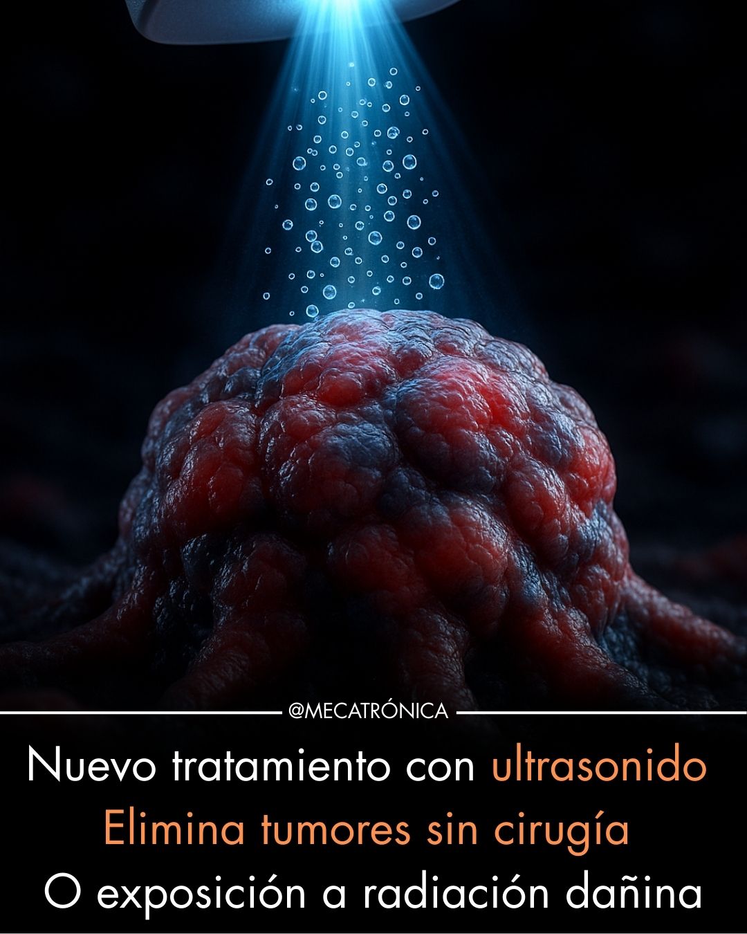 ultrasonido, tumores